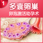 多囊卵巢