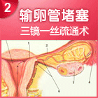 输卵管堵塞
