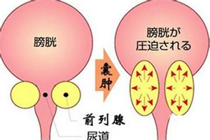 昌吉前列腺囊肿需要做哪些检查