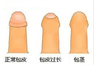 男性谨防包皮包茎，及早诊治才是硬道理