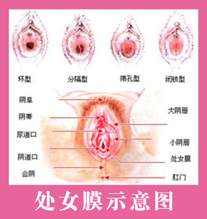 昌吉处女膜修复医院哪家好