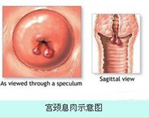 昌吉宫颈息肉的检查项目有哪些