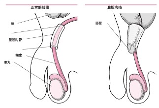 慢性精囊炎的病因和症状有哪些