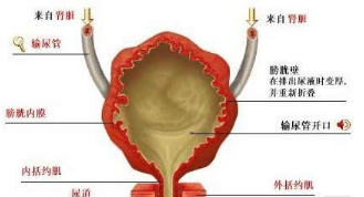 引起膀胱炎原因有哪些