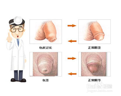 包皮过长危害男性健康吗