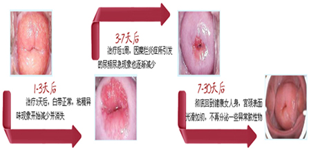 如何预防宫颈糜烂