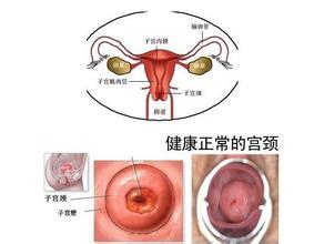 宫颈炎的预兆是怎样的