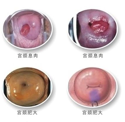 如何正确预防宫颈息肉