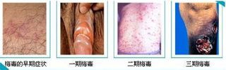 生活中男性应该如何避免梅毒病症