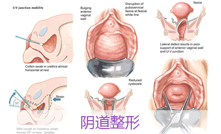 导致女性阴道松弛的原因是什么