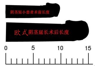 阴茎延长手术后得注意些什么