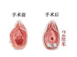 张家口处女膜修补多少钱