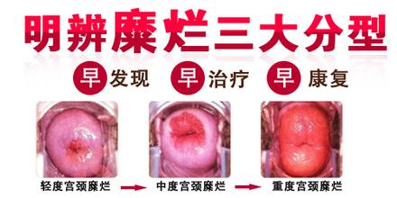 宫颈糜烂引发的并发症有哪些